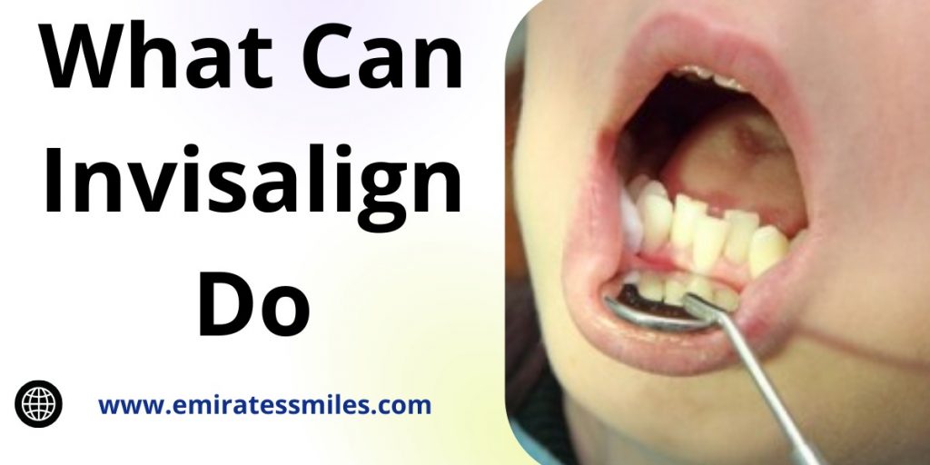 What Can Invisalign Do